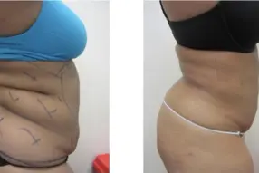 Before and after of lipo 360 by Dr. Drew Varano in Washington DC